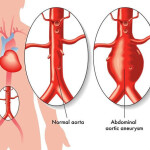 ανεύρυσμα κοιλιακής αορτής